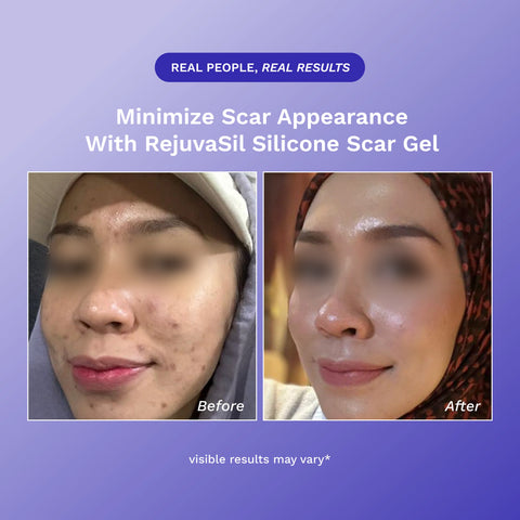 RejûvaSil Silicone Scar Gel 1 oz (8000)