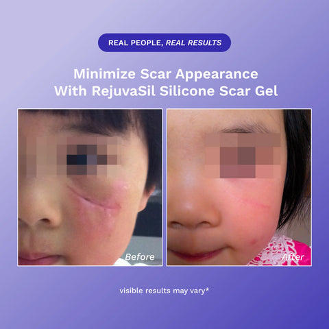 RejûvaSil Silicone Scar Gel 1 oz (8000)