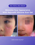 RejûvaSil Silicone Scar Gel 1 oz