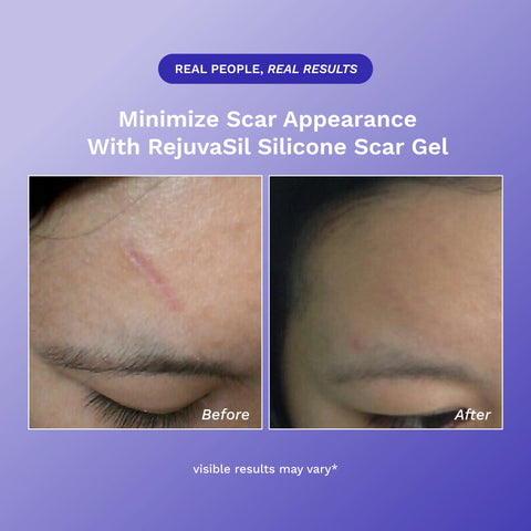 RejûvaSil Silicone Scar Gel 1 oz