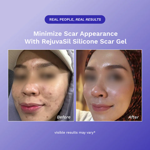 RejûvaSil Silicone Scar Gel 1 oz